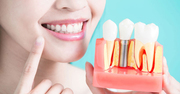 Dental Implants in Kitchener | Dentist in Kitchener